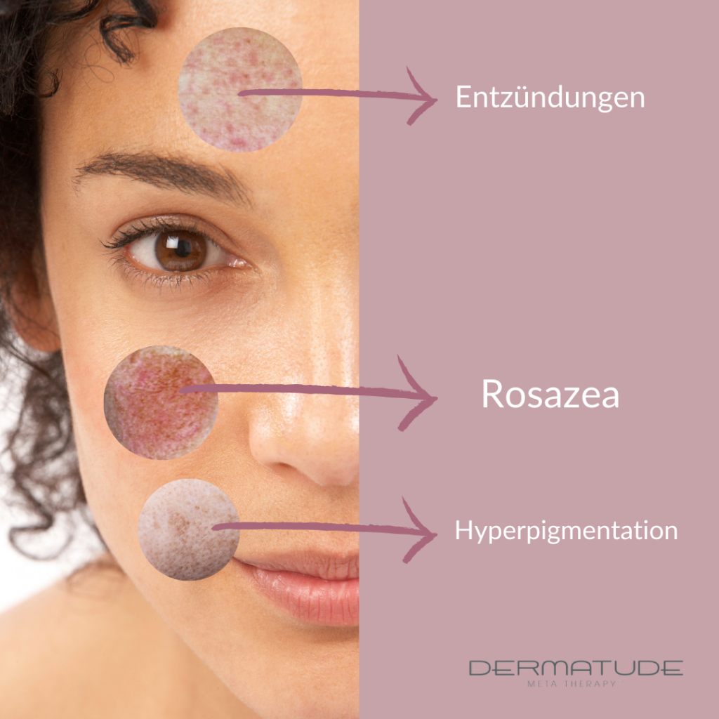 Meta Therapy Dermatologische Behandlung Hautprobleme – Pure Skin Helmstedt