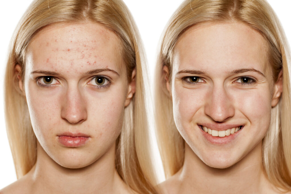 Teenie Gesichtsbehandlung Vorher Nachher – Pure Skin Helmstedt
