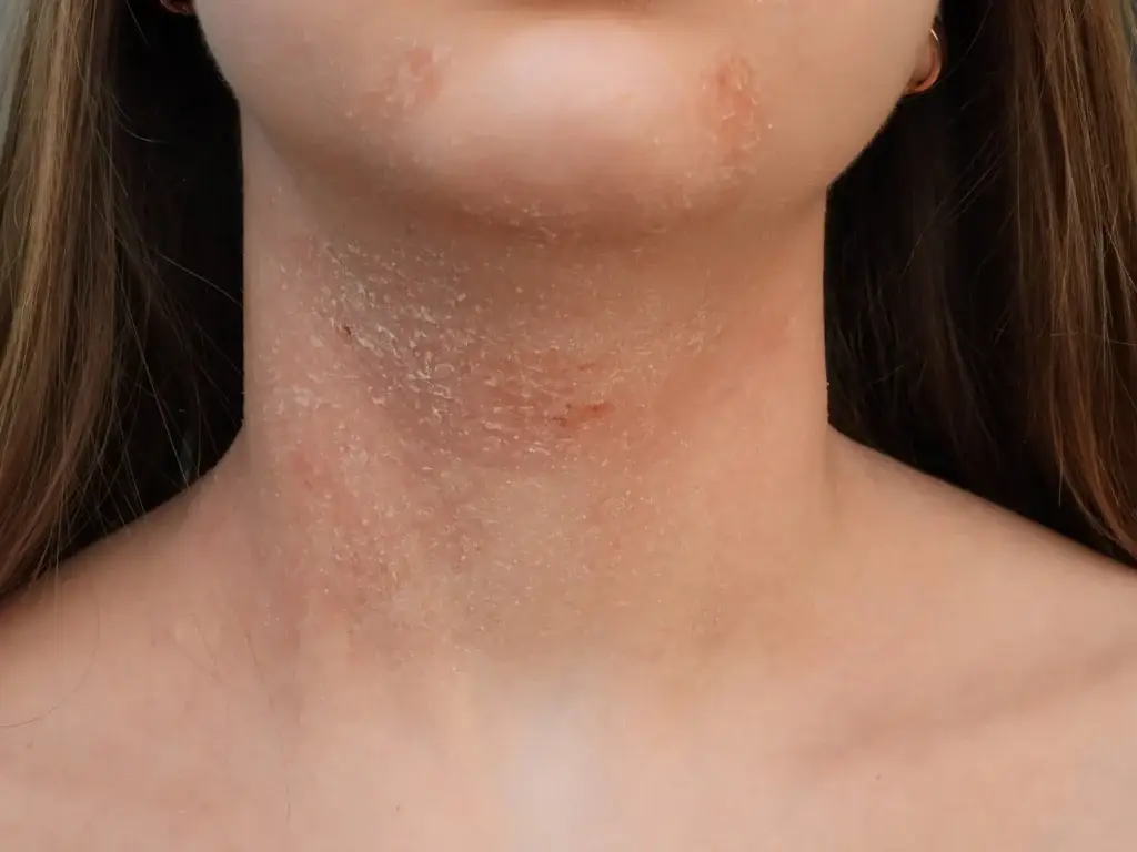 Neurodermitis Behandlung Ergebnis – Pure Skin Helmstedt
