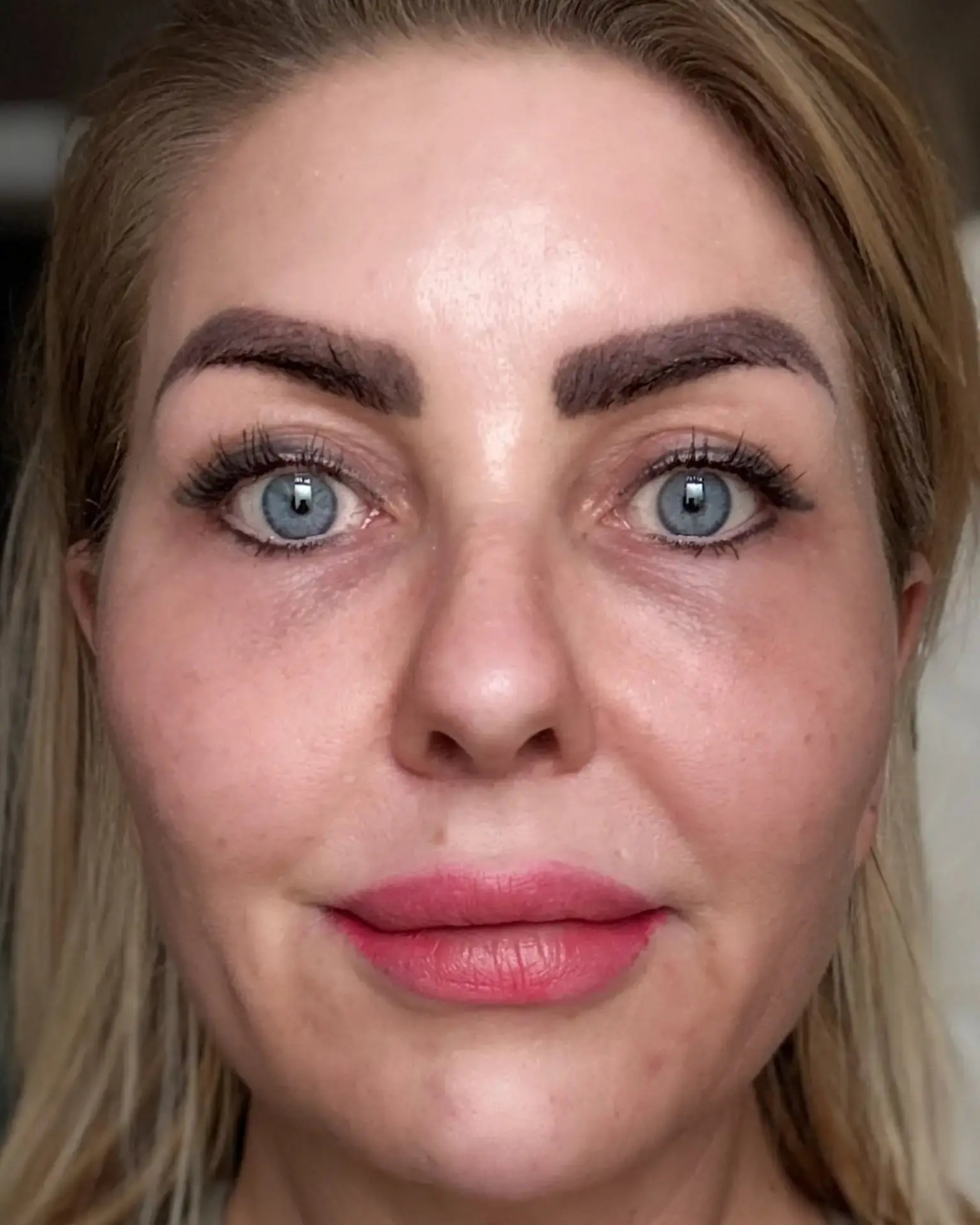 RedTouch Behandlung Nachher – Pure Skin Helmstedt