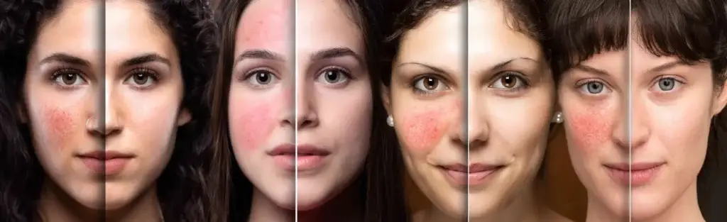 Rosazea Hautbild Behandlung – Pure Skin Helmstedt