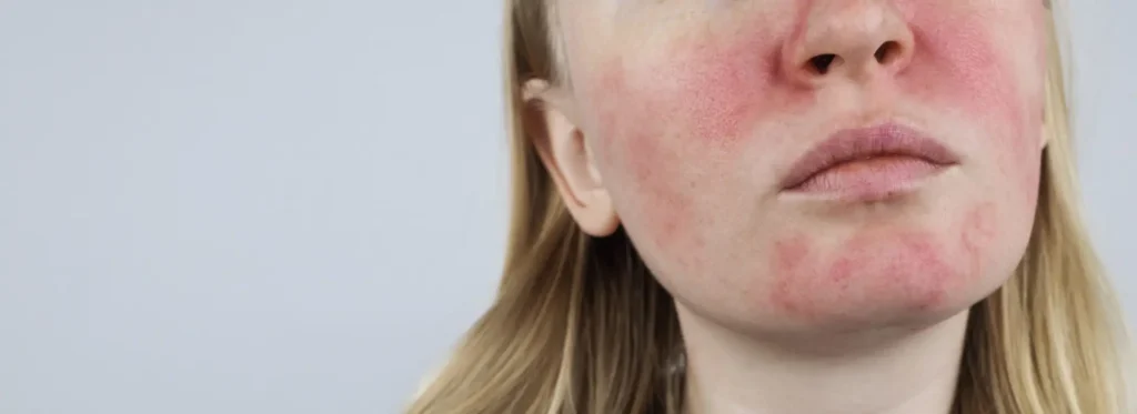 Empfindliche gerötete Haut – Behandlung Pure Skin Helmstedt