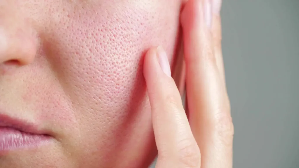 Große Poren Behandlung – Pure Skin Helmstedt