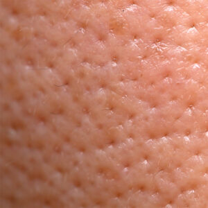 Große Poren Behandlung Helmstedt – Pure Skin