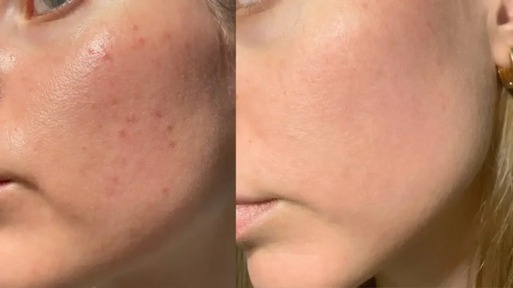 Ölige Haut große Poren Vorher Nachher – Pure Skin Helmstedt