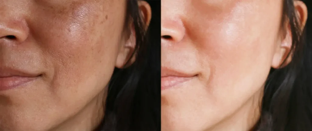 Pigmentflecken Vorher Nachher – Behandlung Pure Skin Helmstedt