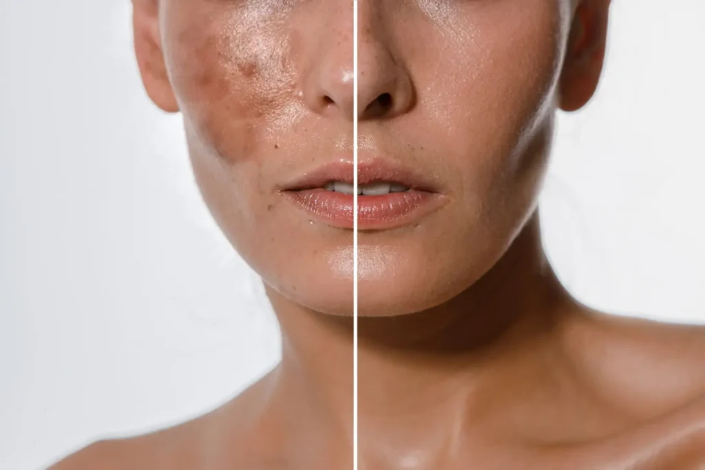 Pigmenflecken Hautverfärbungen Vorher Nachher – Pure Skin Helmstedt