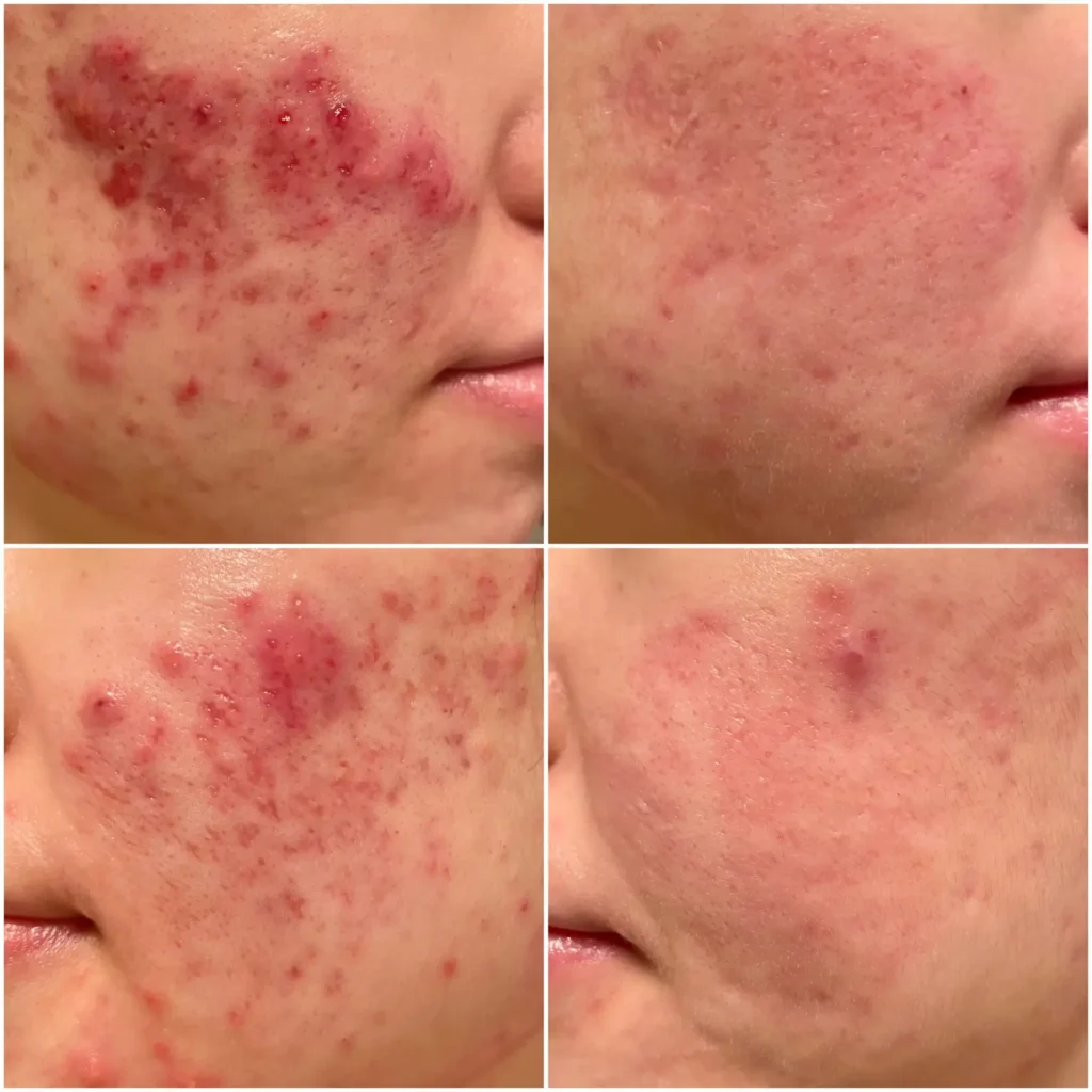 Akne Behandlung Vorher Nachher Ergebnisse – Pure Skin Helmstedt