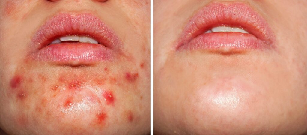 Oxygen Behandlung Vorher Nachher – Pure Skin Helmstedt