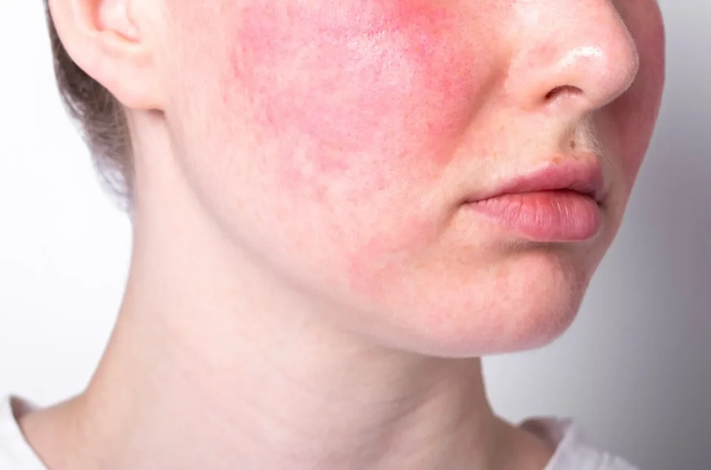 Gerötete empfindliche Haut Gesicht – Behandlung Pure Skin Helmstedt