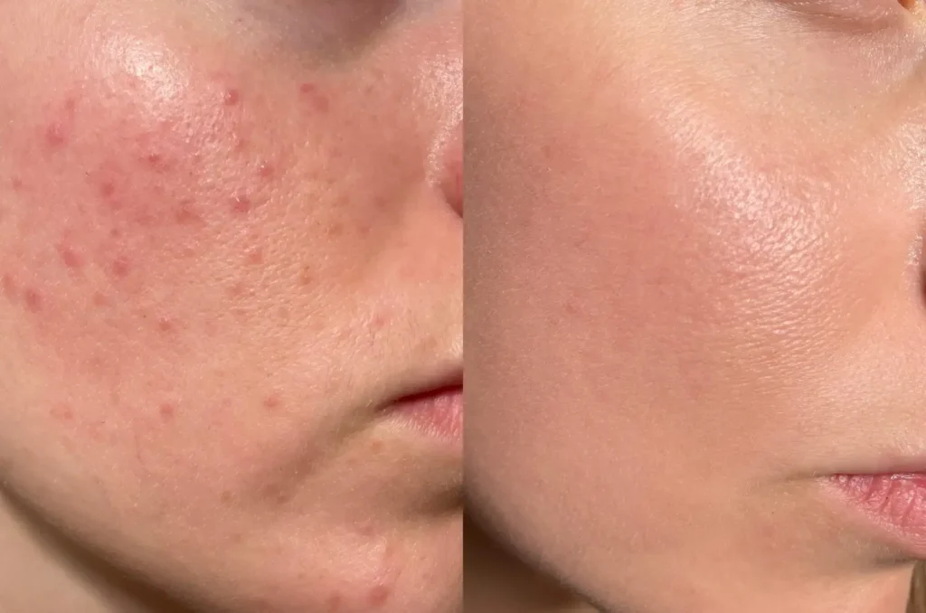 Teenie Gesichtsbehandlung Akne Vorher Nachher – Pure Skin Helmstedt