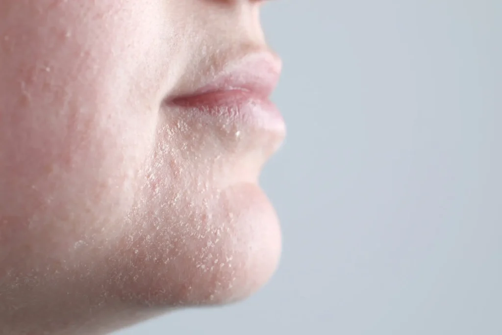 Trockene Haut Gesicht – Pure Skin Helmstedt