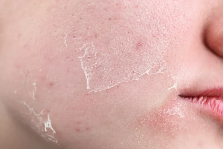 Trockene fahle Haut – Behandlung Pure Skin Helmstedt