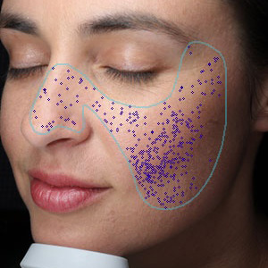 VISIA UV-Schäden Analyse – Hautanalyse Pure Skin Helmstedt