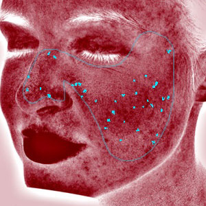 VISIA Rötungen Analyse – Hautanalyse Pure Skin Helmstedt