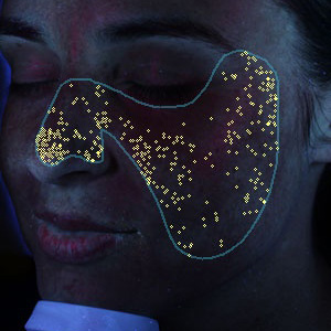 VISIA Akne Bakterien Analyse – Hautanalyse Pure Skin Helmstedt
